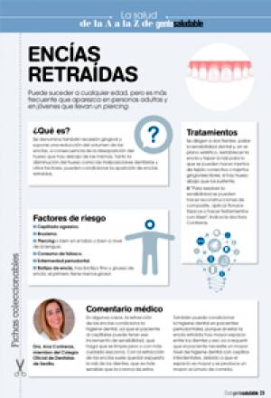 Encías retraídas