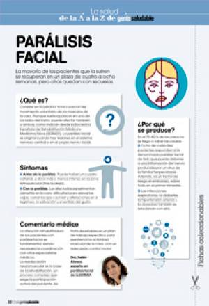 Parálisis facial