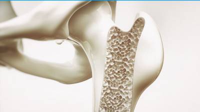 Osteoporosis: Rompe con ella ¡ya!